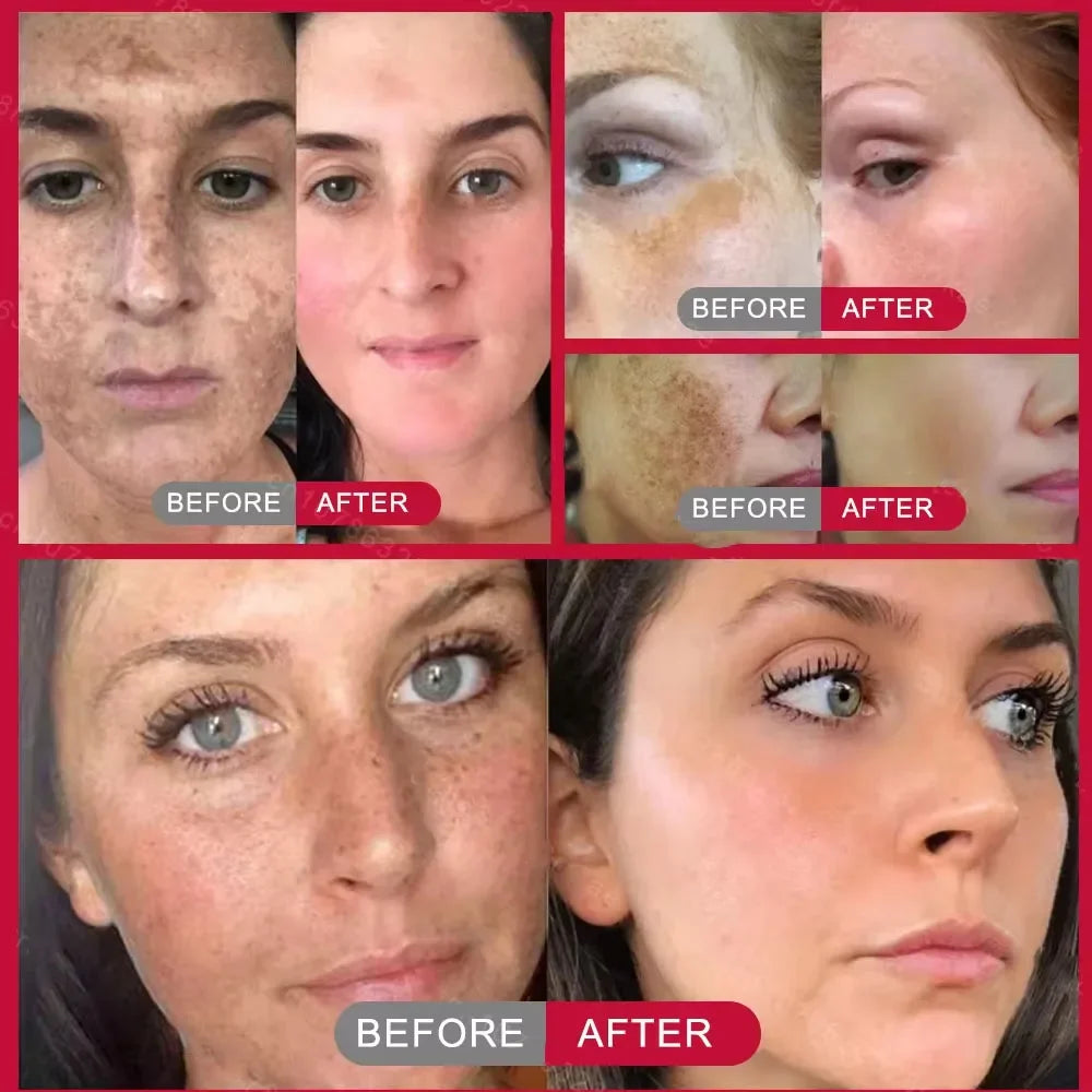 Powerful Whitening Freckles Face Cream Dark Spot Corrector Removal Melasma Fade Melanin Pigmentation Brighten Skin Care Products