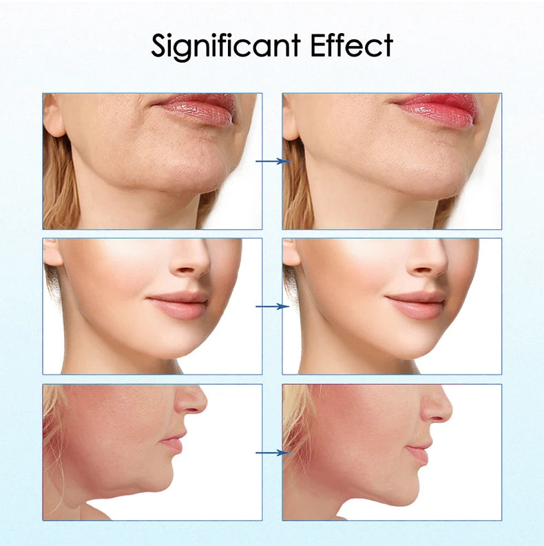 Face Lifting Device Red Light Skin Rejuvenation V Face Massager Double Chin Lift Up with Remote Control Facial Beauty Instrument