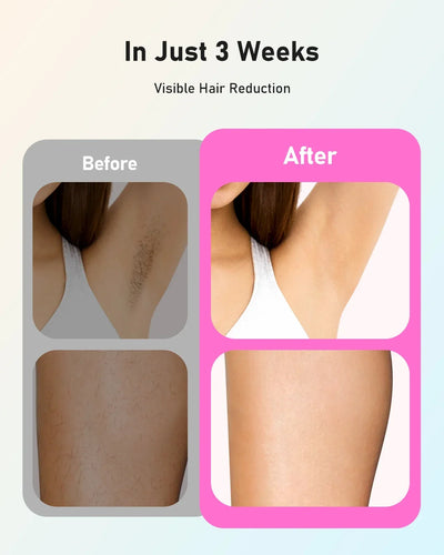 990000 Flashes Laser Hair Removal for Women and Men Body Bikini and Facial Areas Painless Permanent HairRemoval IPL Hair Removal