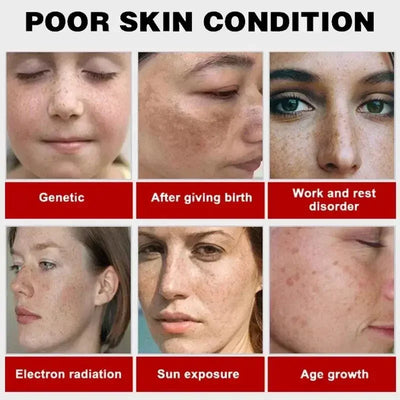 Powerful Whitening Freckles Face Cream Dark Spot Corrector Removal Melasma Fade Melanin Pigmentation Brighten Skin Care Products