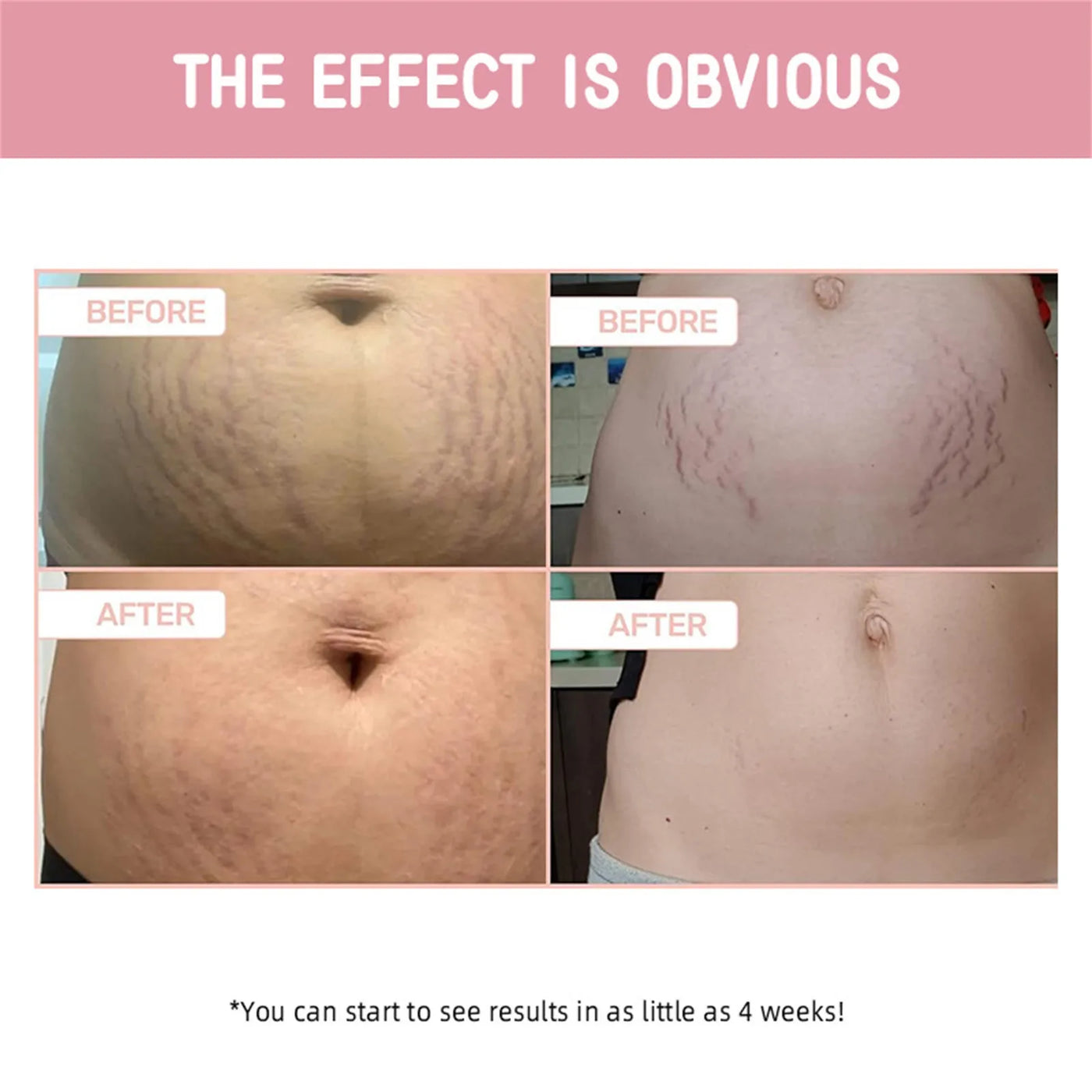 Abdominal Firming Cream 100ml, Lifting And Firming, Fading And Growth Lines, Cream, Firming And Repairing Stretch Marks And Scar