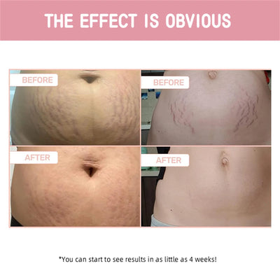 Abdominal Firming Cream 100ml, Lifting And Firming, Fading And Growth Lines, Cream, Firming And Repairing Stretch Marks And Scar