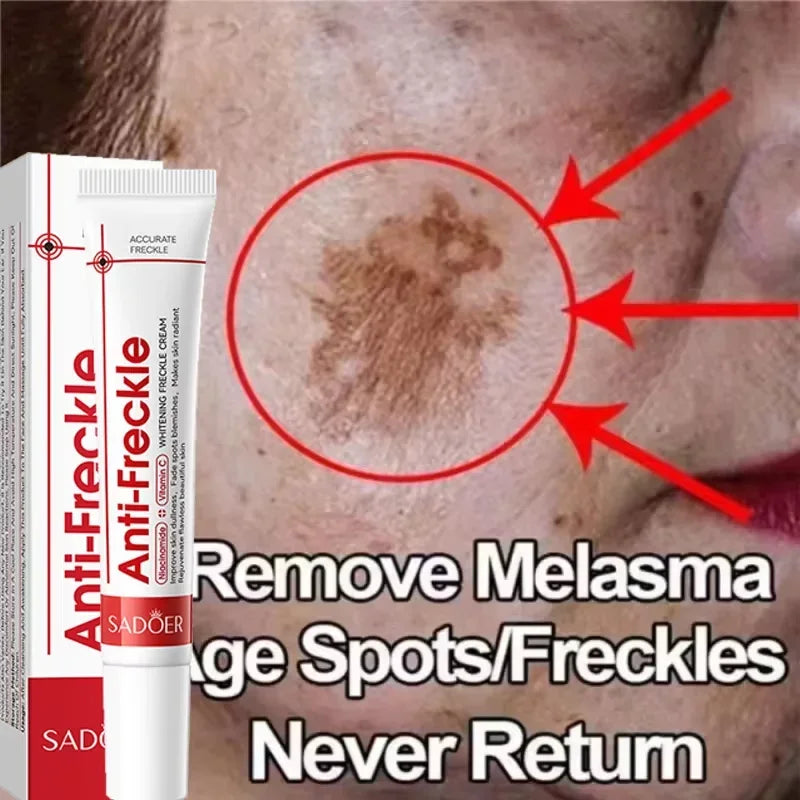Powerful Whitening Freckles Face Cream Dark Spot Corrector Removal Melasma Fade Melanin Pigmentation Brighten Skin Care Products