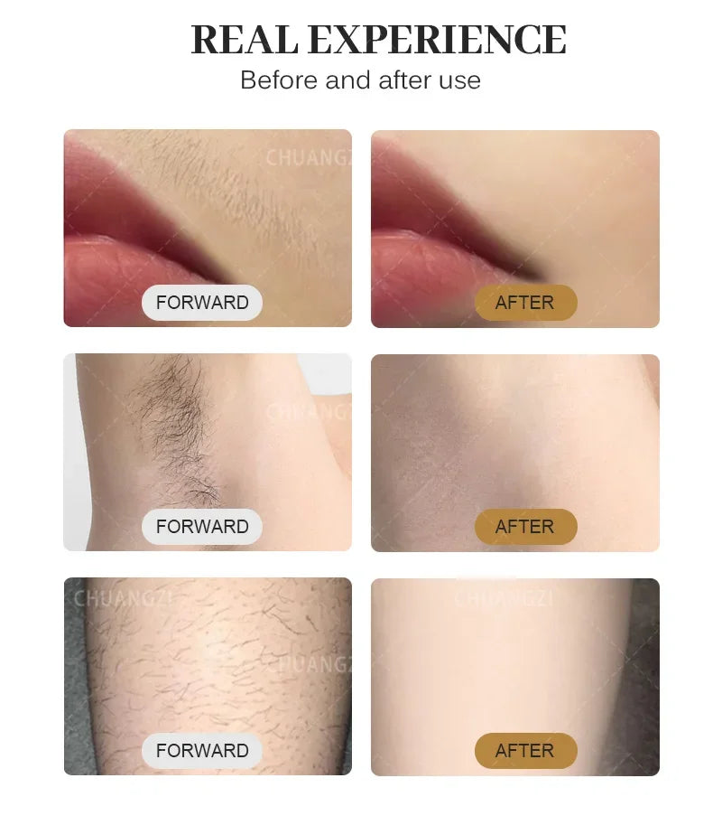 Diode Laser Hair Removal Device Uses Advanced Laser Technology to Accurately Remove Hair and Achieve Long-Lasting Results