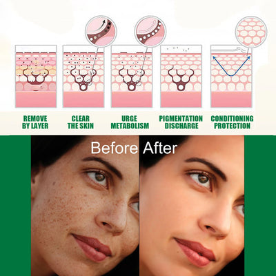 Melanin Correcting Facial Serum Freckles Removal Removes Stains Brightening Skin Lightening Products Moisturizing Facial Serum