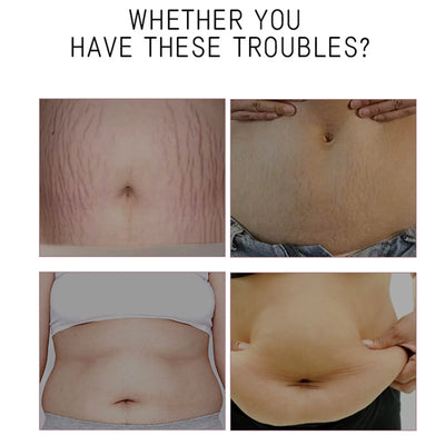 Abdominal Firming Cream 100ml, Lifting And Firming, Fading And Growth Lines, Cream, Firming And Repairing Stretch Marks And Scar